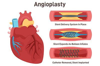 Angioplasty before